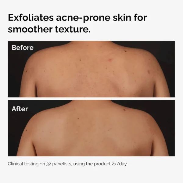 Salicylic Acid 0.5% Body Serum - Image 4